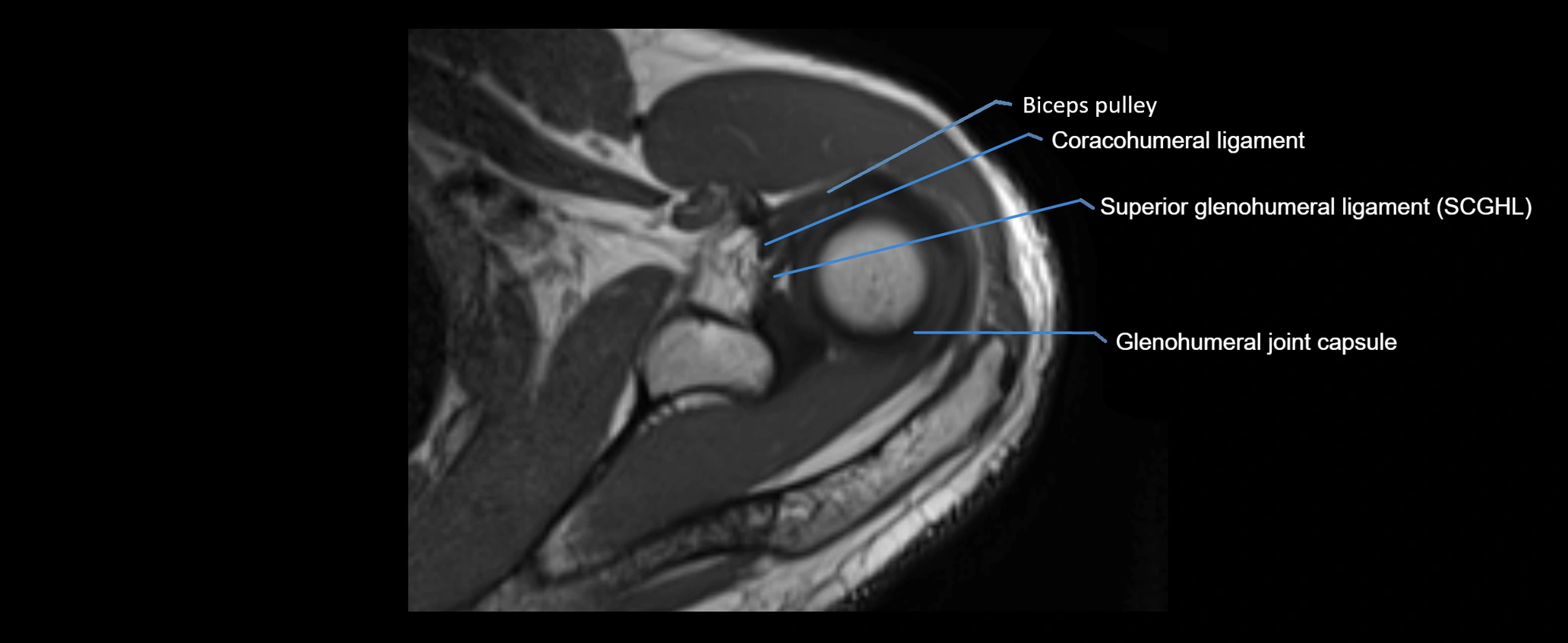 shoulder ligaments axial 3d 3t mri image-img-00005-00044.webp